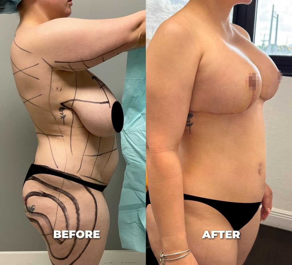 before and after mommy makeover recovery