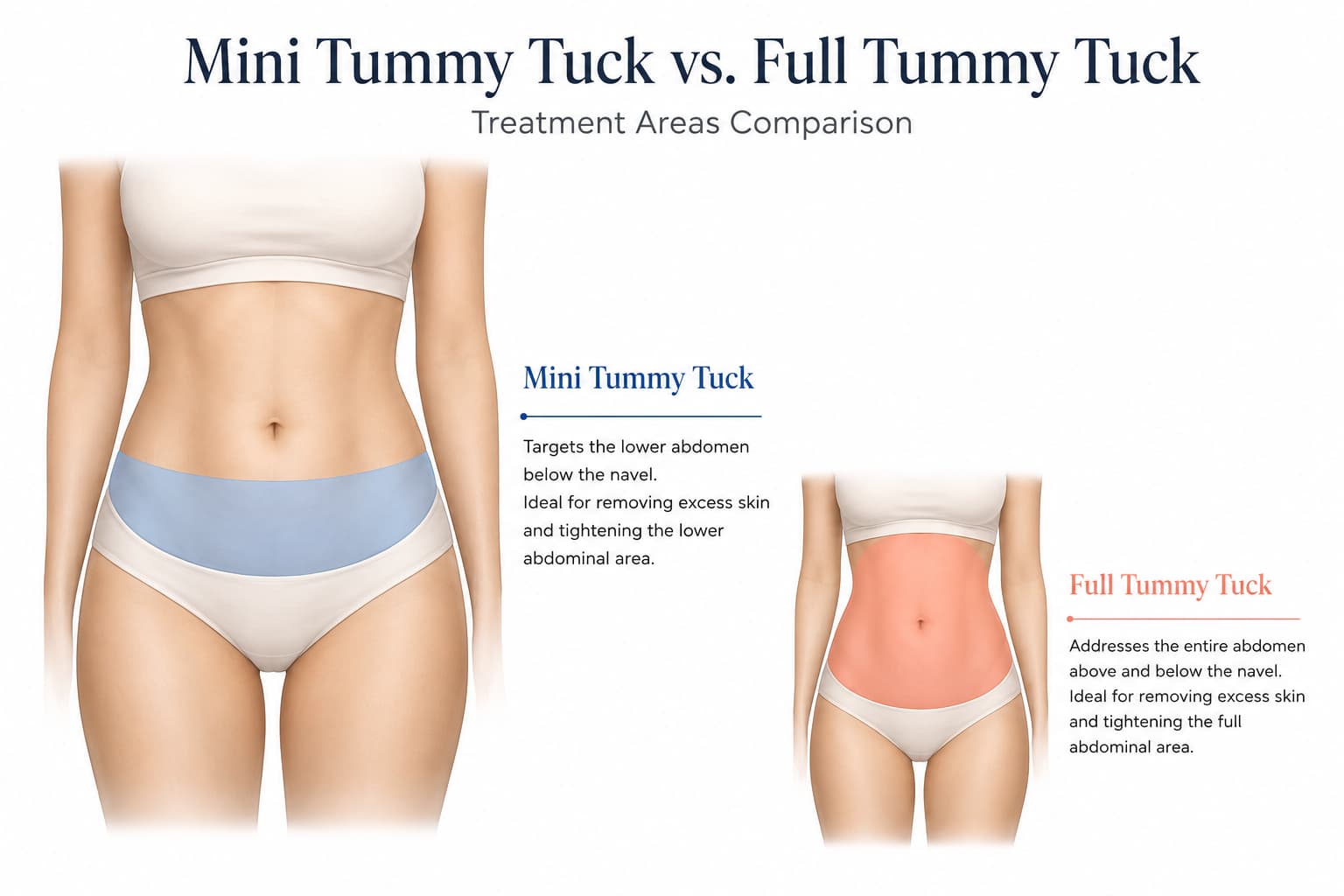 Anatomical illustration comparing the mini tummy tuck treatment area below the navel to the full tummy tuck area
