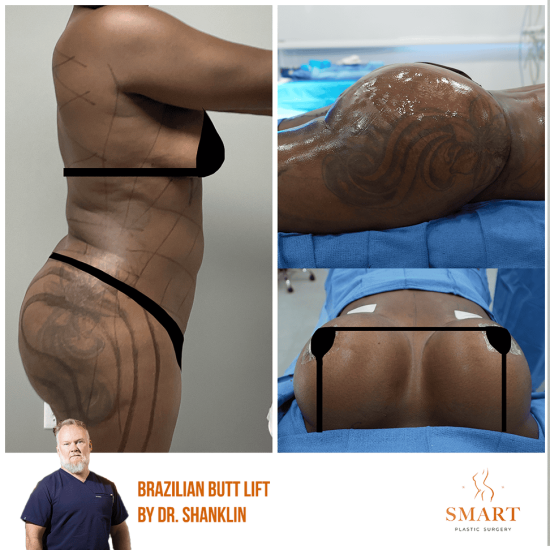 Lipo-360
