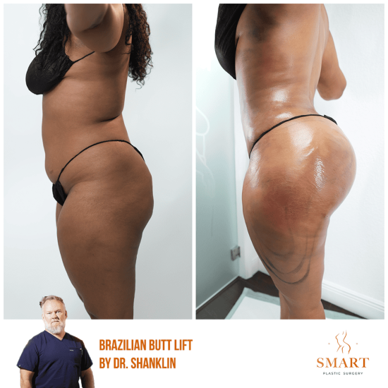 breast-augmentation-2