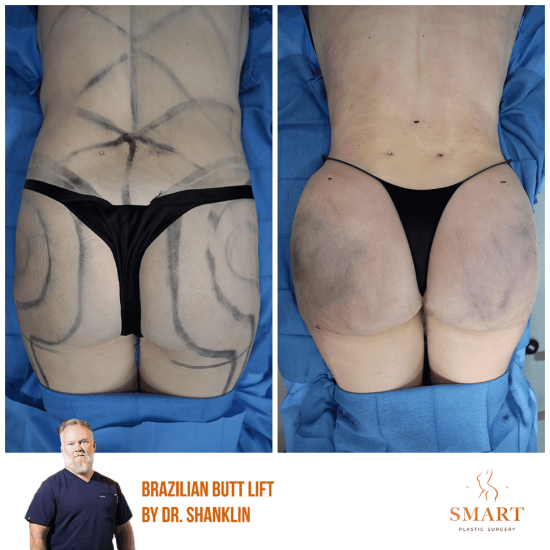 breast-augmentation
