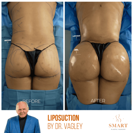 lipo-2-1024x1024